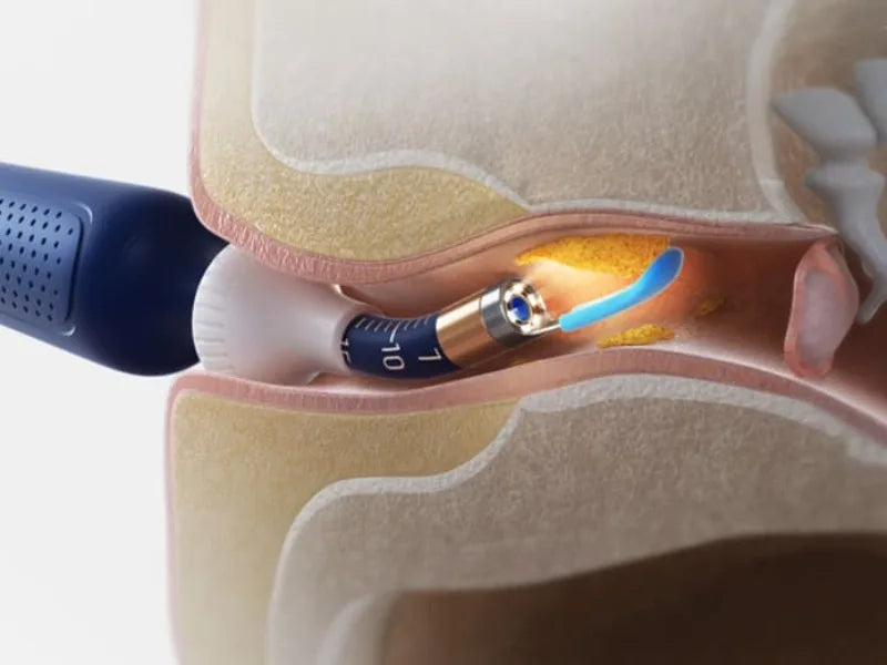 Visual Ear Wax Remover