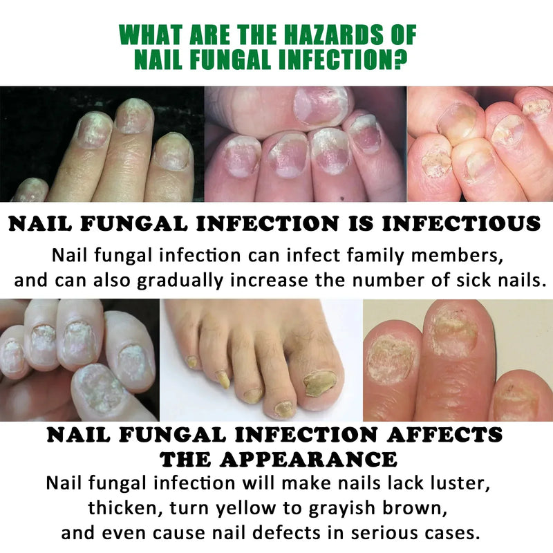 Nail Fungus Defender Serum