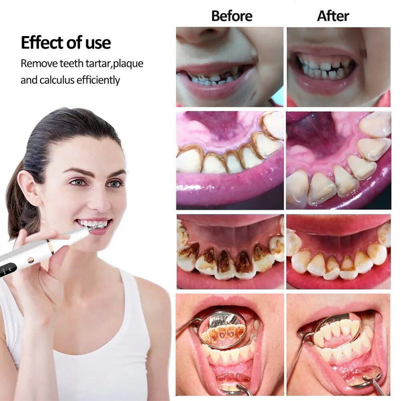 Electric Dental Calculus Remover