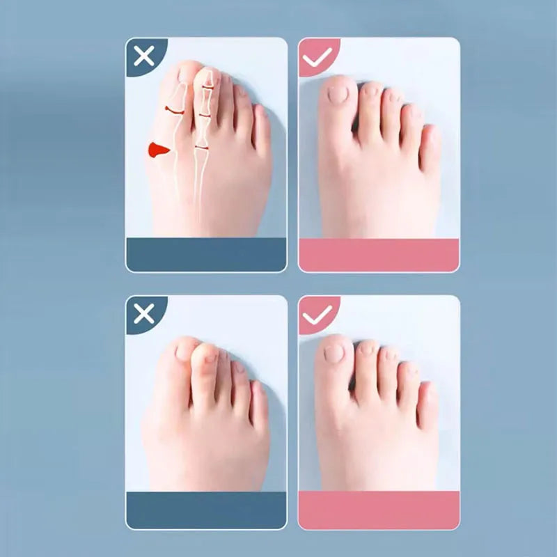 Silicone Hallux Valgus Bunion Corrector