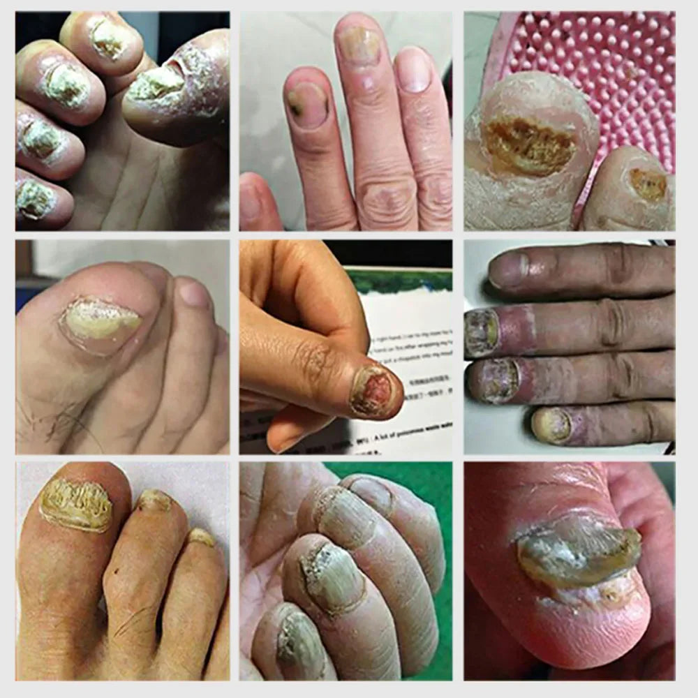 Nail Fungus Defender Serum