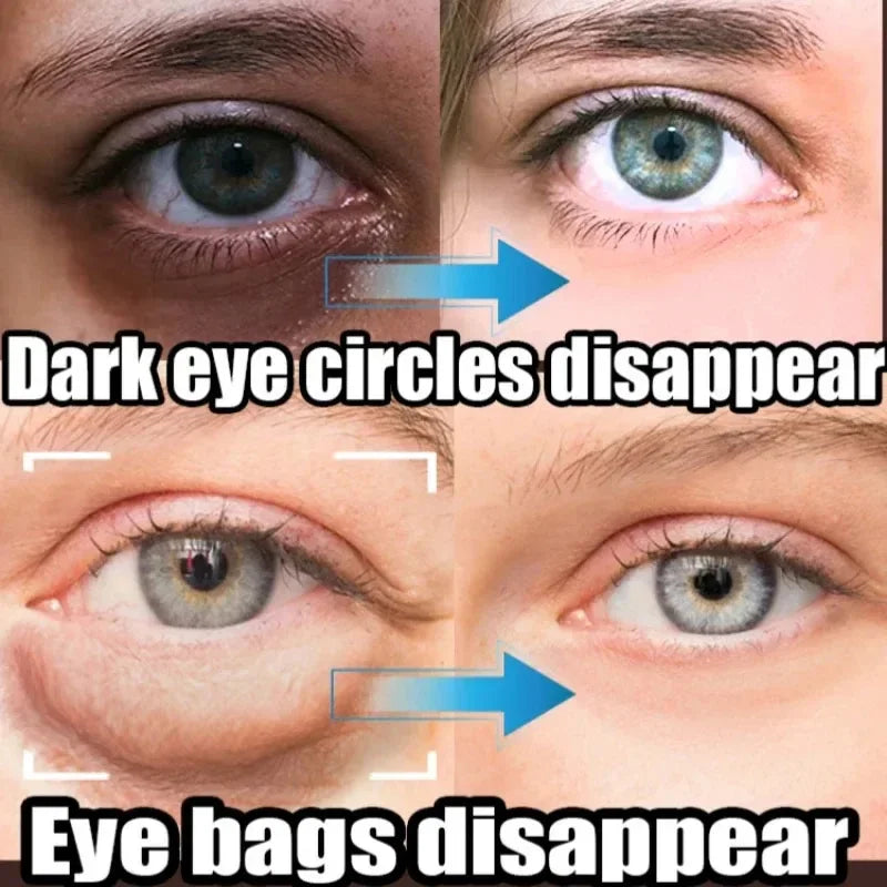 Instant Eye Bag Removal